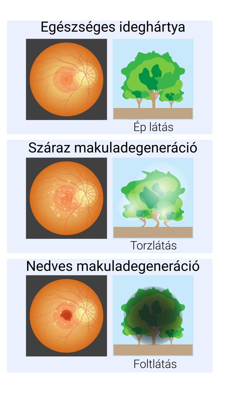 makuladegeneracio-tunetek