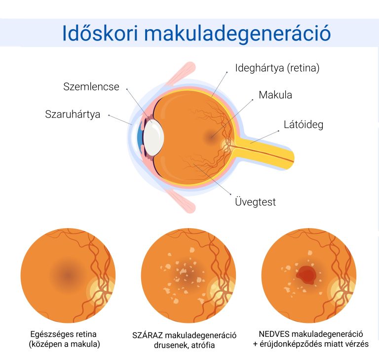 makuladegeneracio