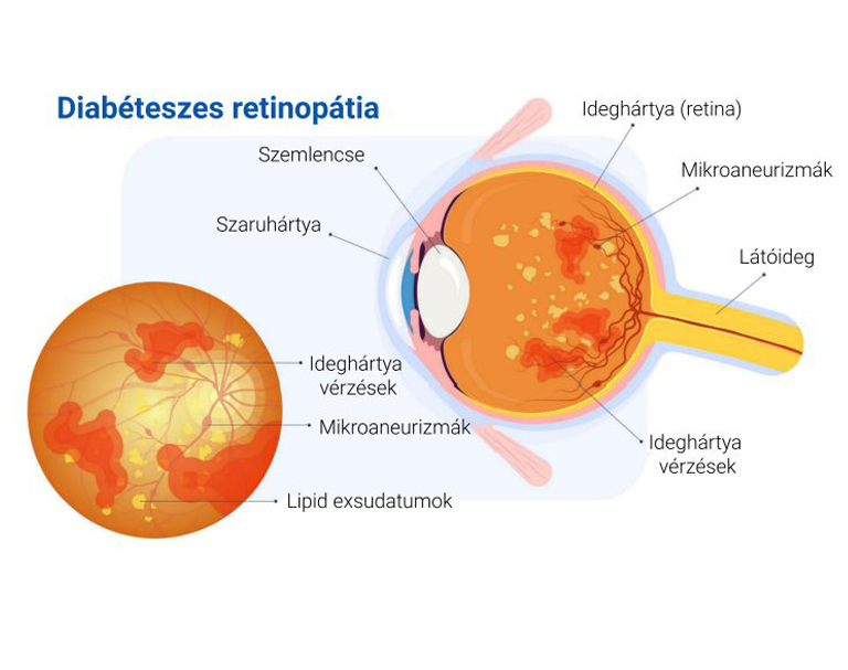 retinopatia-02